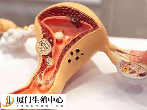 受精时注入速度过快可能会出现子宫内膜异位