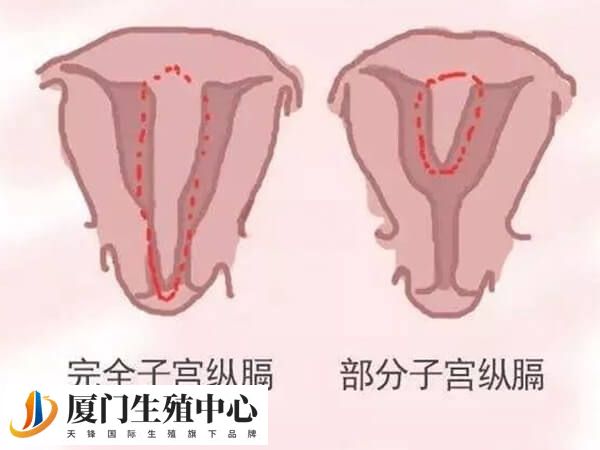 纵隔子宫的危害除了反复流产还有什么？